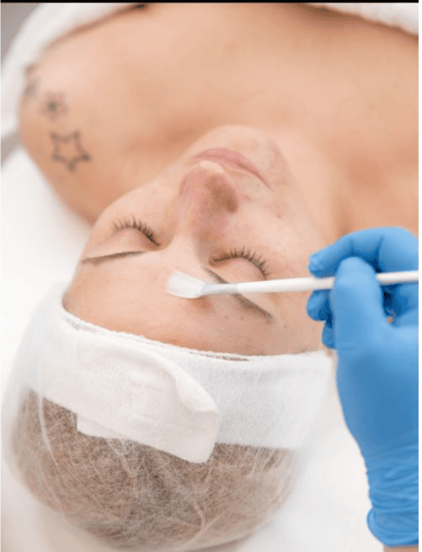 Chemical Peels